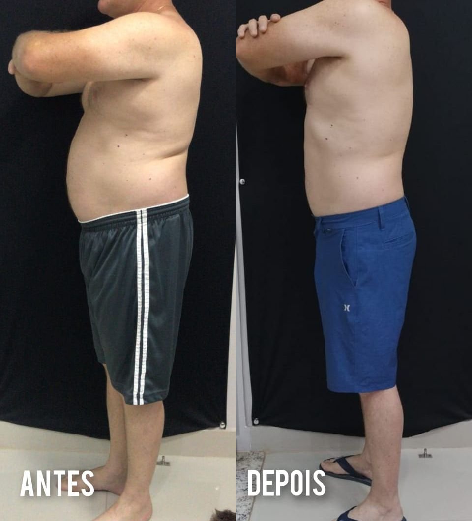 Evolução real de paciente: antes e depois, vista lateral
