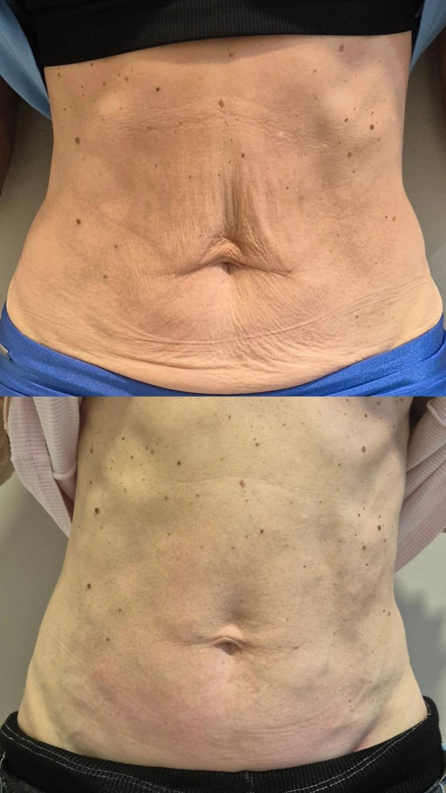 Evolução real de paciente: região abdominal antes e depois do tratamento