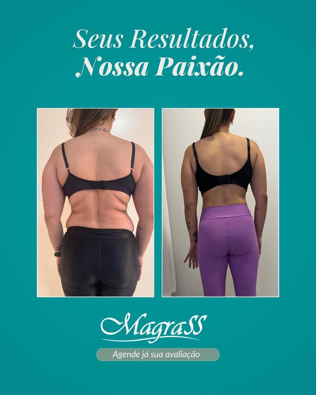 Evolução real de paciente Magrass: antes e depois, vista posterior